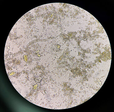 strongyloides stercoralis larva in stool exam.