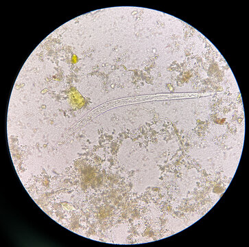 strongyloides stercoralis larva in stool exam.