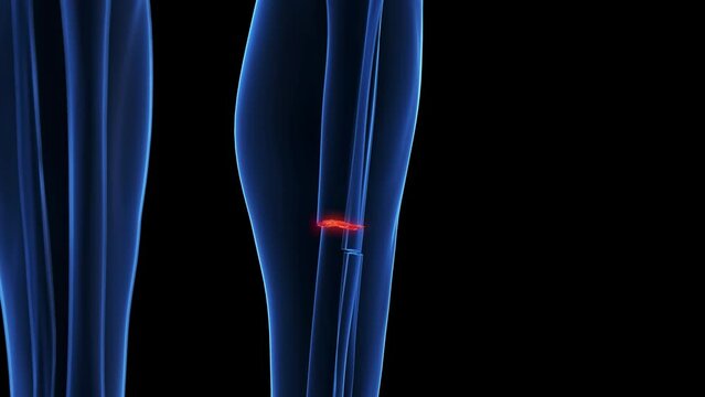3d rendered medical animation of a broken tibia