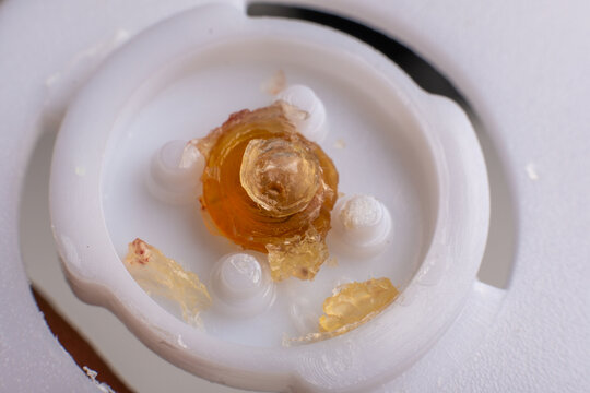 closeup photo of real eye lens removed from human suffering from cataract