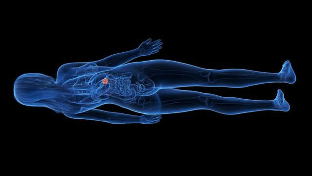 3d rendered medical animation of a kidney tumor