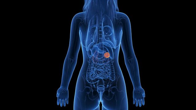 3d rendered medical animation of a kidney tumor