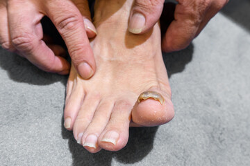 big toe of a person suffering from onychomycosis, a fungal infection - obrazy, fototapety, plakaty