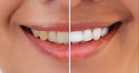 Closeup smiling asian woman Teeth comparison Before and After teeth whitening treatment from yellow...