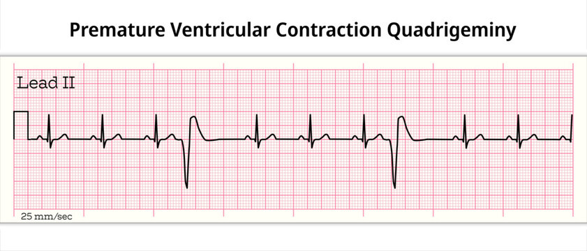 ECG Premature Ventricular Contraction Trigeminy - 8 Second ECG Paper