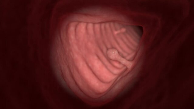 3d rendered medical animation of colon polyps