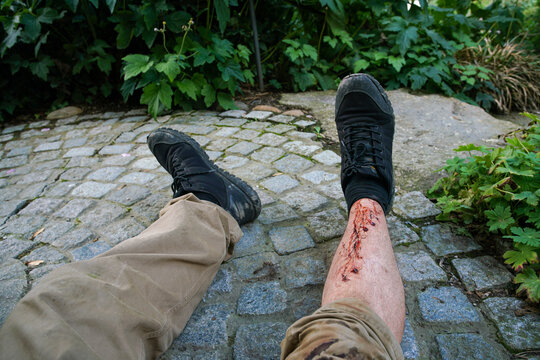 Light superficial wounds on the skin of the leg - caused by falling on a fast escalator in a German chain German store in Hanover