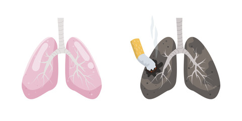 Illustration of healthy lungs vs. smoker's lungs. 
