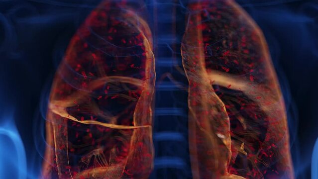 3d rendered medical animation of an infected lung 