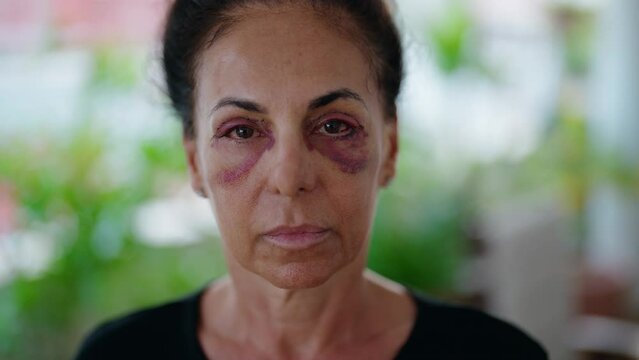 Middle age hispanic woman suffering for domestic violence with bruise on eyes at home terrace