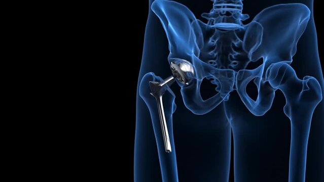 3d rendered medical animation of a hip replacement
