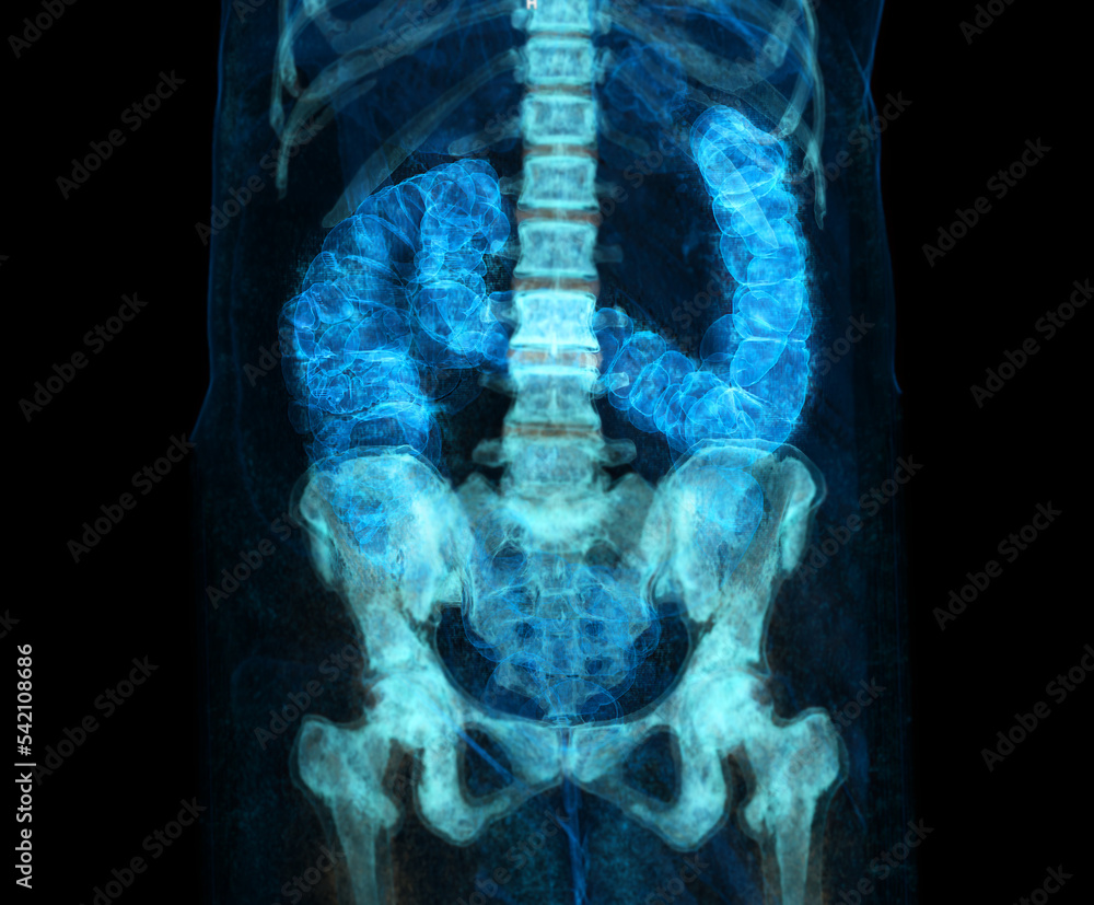 Poster ct colonography or ct scan of colon 3d rendering image for screening colorectal cancer. check up scr