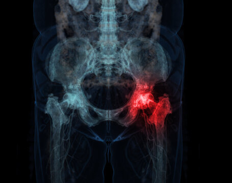 3D rendering Pelvic bone and hip joint 3D isolated on black background.