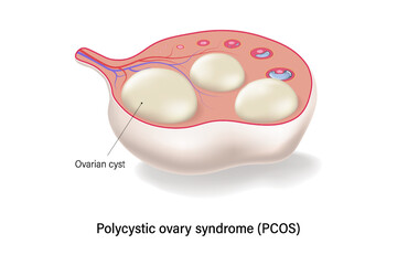 Polycystic ovary syndrome PCOS cross section vector. Ovarian cysts. Female ovarian disease. - obrazy, fototapety, plakaty