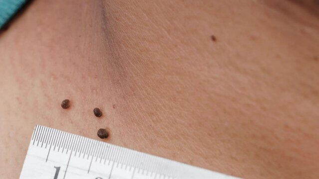 Close up of warts growing around the neck of an adult asian man