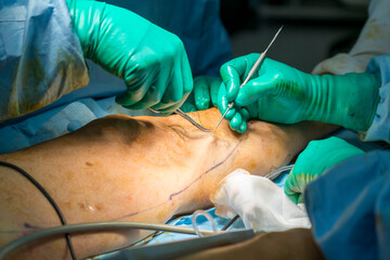Varicose vein surgery step by step in operating room.