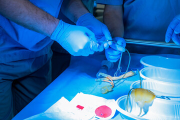 penis penile implant, penis enlargement surgery, balloon insertion inflation, penile prosthesis