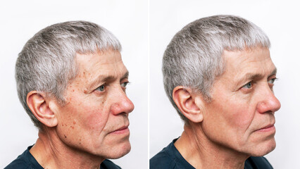 Elderly caucasian man before and after getting rid of moles and age spots on the face isolated on white background. Result of treatment. The result of a cosmetic procedure, laser removal - obrazy, fototapety, plakaty