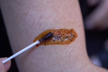 surgical suture wound on the arm treatment of the wound with iodine