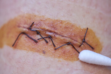 surgical suture wound on the arm treatment of the wound with iodine