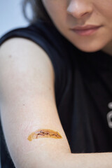 the girl looks at the wound after surgery, surgical suture, wound on the arm, iodine treatment of...