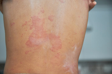 Fototapeta premium Itchy skin, dermatitis, food allergies. baby showing her back with acne, red spots. Baby's having itching, scratching her body with allergy rash..