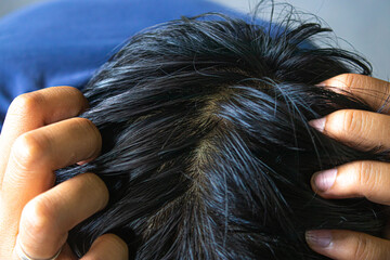 Closeup of thick hair on the scalp of a man's head. - obrazy, fototapety, plakaty