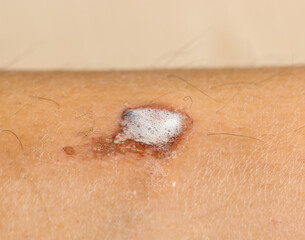 treated wound on the skin as a background