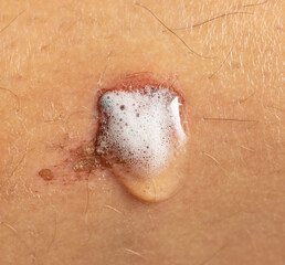 treated wound on the skin as a background