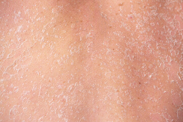 Sunburn, close-up of human skin. Flaky skin from allergies, peeling or eczema. Dry skin in need of...