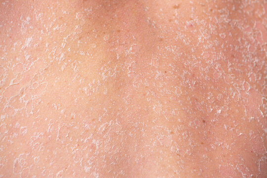 Sunburn, close-up of human skin. Flaky skin from allergies, peeling or eczema. Dry skin in need of treatment and hydration.