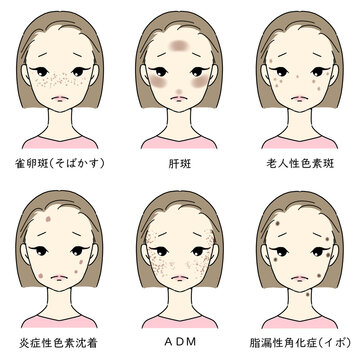 シミ・そばかすに悩む女性セット　シミの種類　文字あり　
