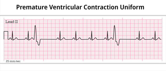 ECG Premature Ventricular Contraction Uniform - Unifocal - 8 Second ECG Paper - Ventricular Extrasystole