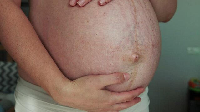 A large belly with stretch marks on the skin and a bulging navel in a pregnant girl in the last month of pregnancy. Maternal health, motherhood. Natural childbirth or caesarean section. Close-up