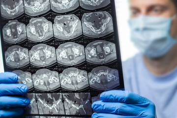 Doctor attentively examines the MRI scan of the patient.