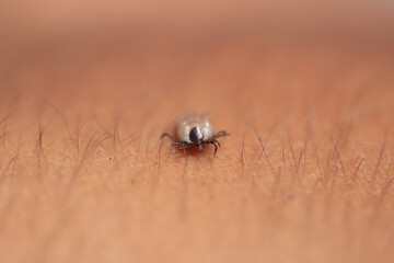 Tick filled with blood sitting on human leg skin. Ixodes ricinus or scapularis. Close-up of...