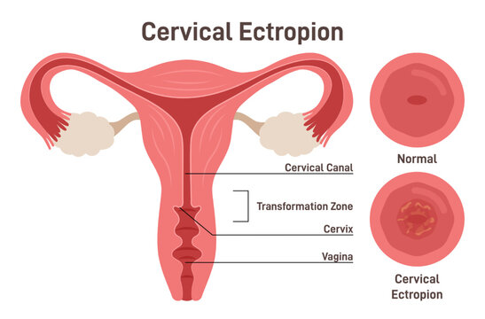 Cervical ectropion or erosion. Cervical canal cells extend on to the surface