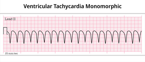ECG Ventricular Tachycardia – Monomorphic VT - 8 Second ECG Paper