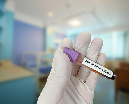Scientist holds blood sample for BCR-ABL RNA Quantitation test in hospital room background.