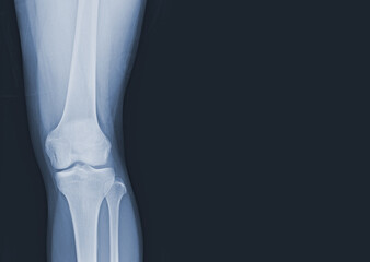Film x-ray of human knee normal joints and ligaments Medical image concept.