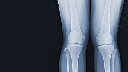 Film x-ray of human both knee standing views normal joints and ligaments Medical image concept.
