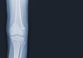 Film x-ray of human knee showing closed fracture,right distal femur , normal joints and ligaments...