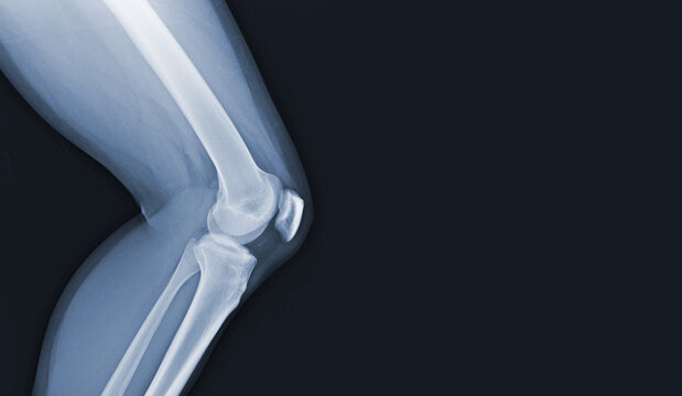 Film x-ray of human knee normal joints and ligaments Medical image concept.