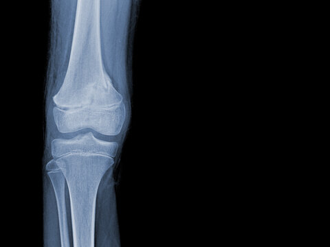 Film x-ray of human knee showing closed fracture,right distal femur , normal joints and ligaments Medical image concept.