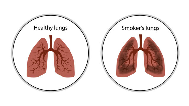 Healthy lungs and smokers lungs icon in circles isolated on white. Cartoon style. Icon or design element.