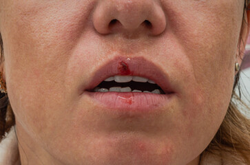 Bloody herpes wound on woman lips