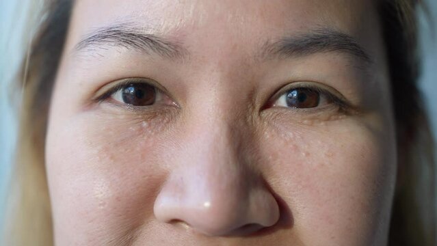 Syringoma milia milium cysts or seborrheic keratosis on asia people female face body care. Close-up young adult asian woman under eye small acne liver spot skin issue smile with pride look at camera.