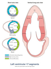 When the frontal QRS axis is located at +80°, it is  located on the negative side of the aVL lead axis, and the QRS main wave in lead aVL is negative.
