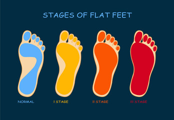 Stages of flat feet. Deformation of the foot. 