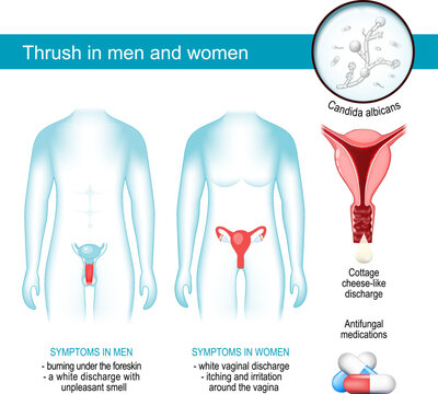 Thrush in men and women. yeast infection.